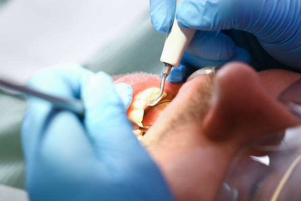 Best Broken or Chipped Tooth Repair in Conover, NC